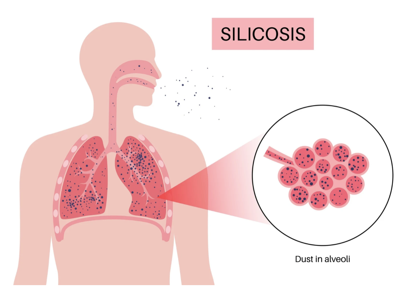 Graphic showing human figure with lungs, and what silicosis looks like